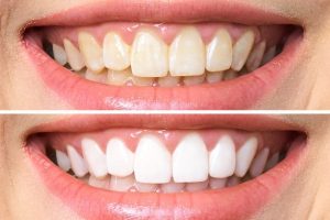 Teeth Whitening Kits