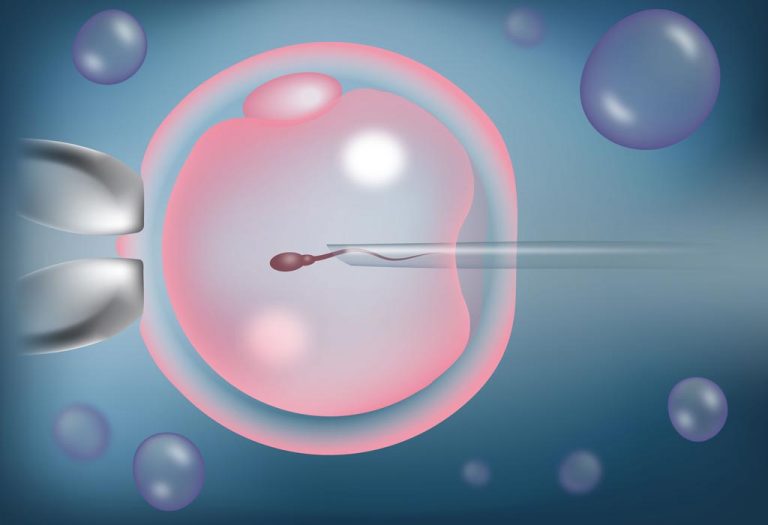 Marvel of Intracytoplasmic Sperm Injection (ICSI) for Fertility Solutions